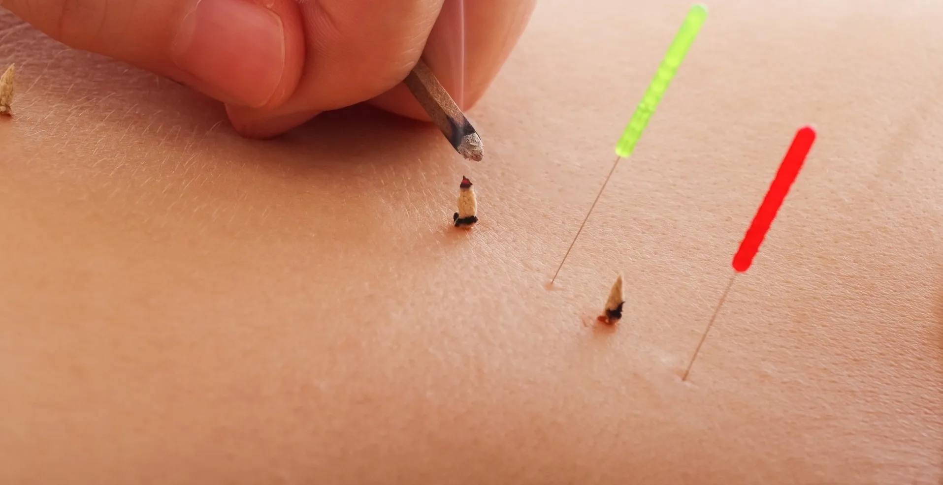 身体のお悩みにアプローチした鍼灸