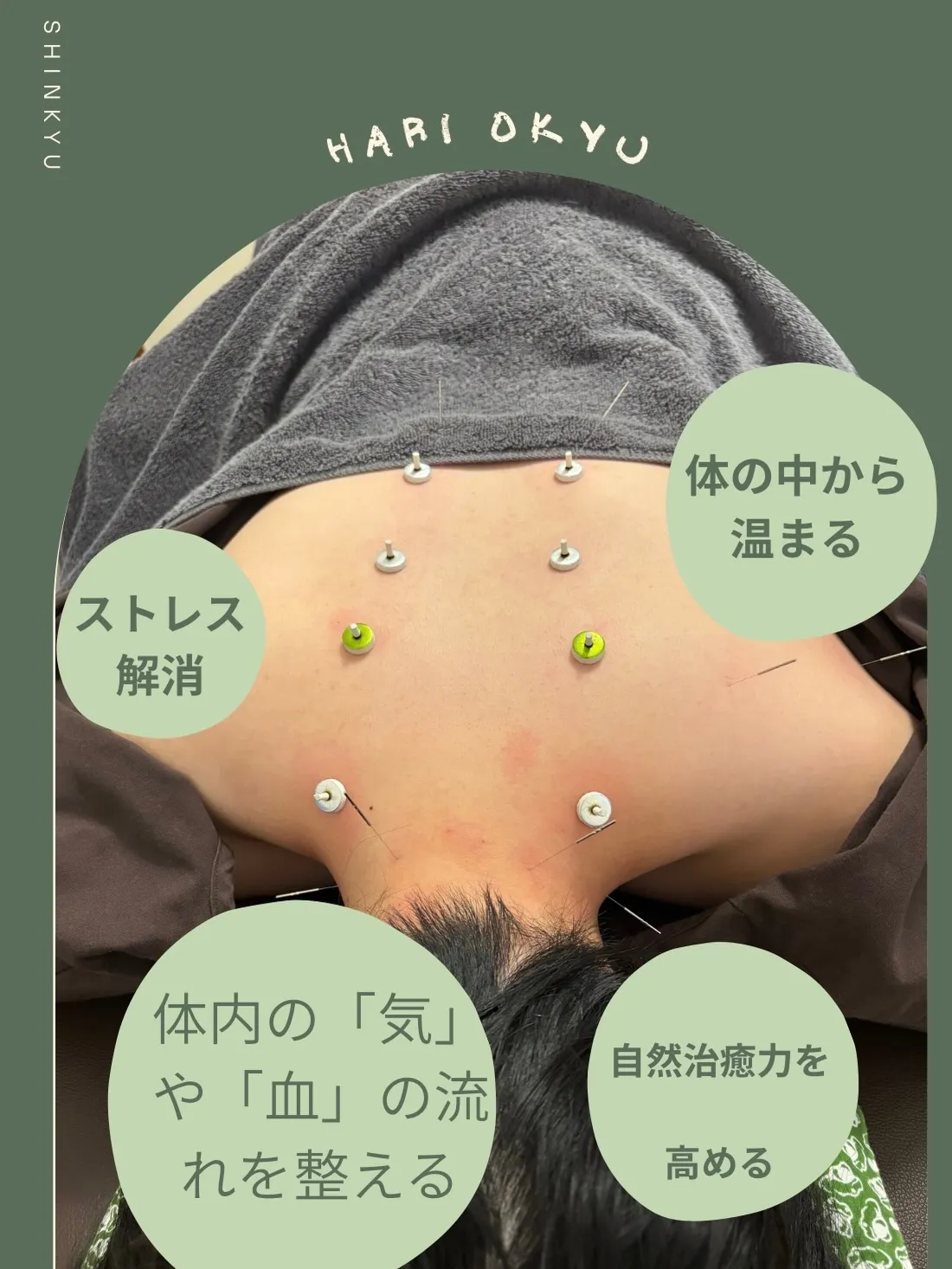【東洋医学の力で冷えを改善! 鍼灸で体の中から温まる】