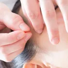 美容鍼